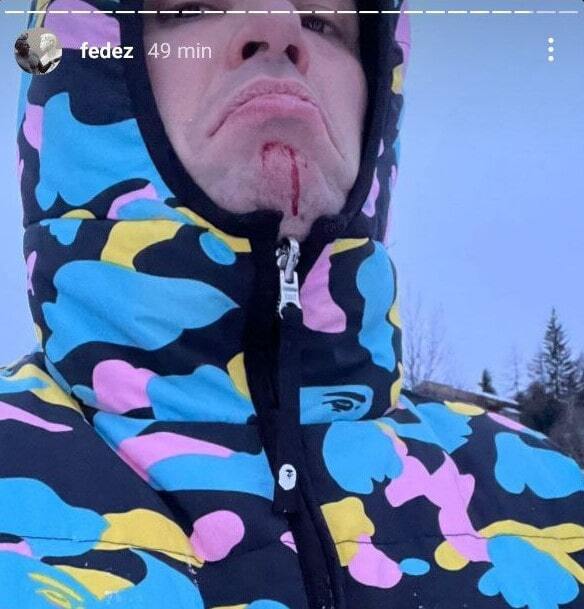 fedez incidente in montagna