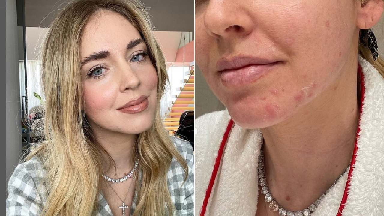 Chiara ferragni messaggio sull'acne