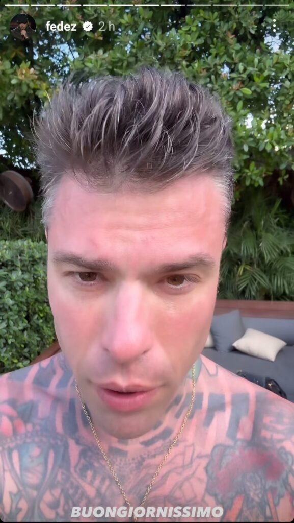 Fedez si ustiona a Miami