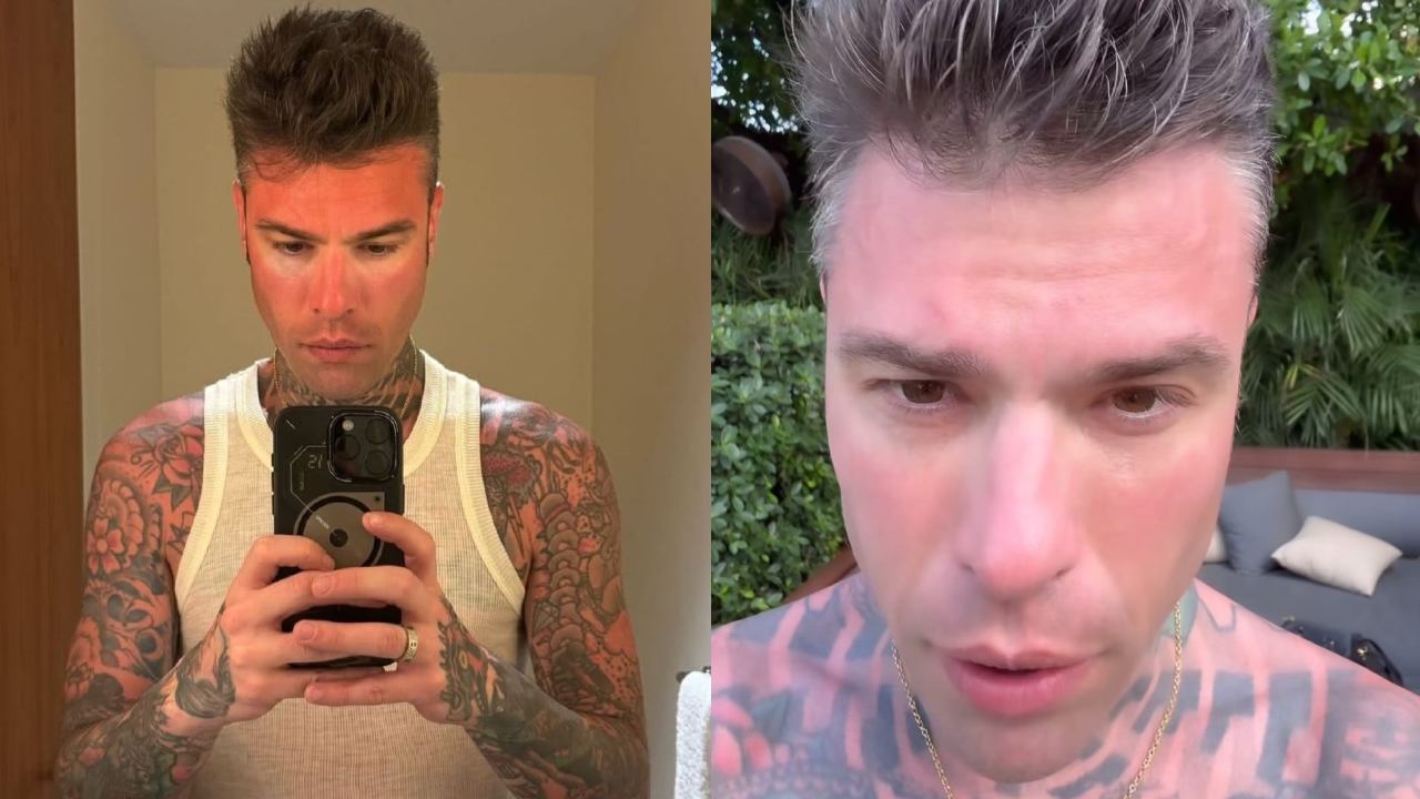 Fedez si ustiona in vacanza a Miami