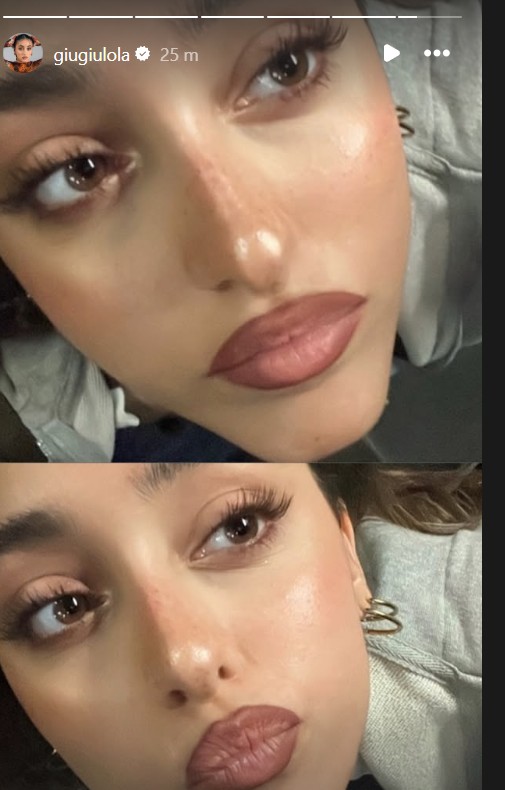 Giulia Stabile Ritocco Labbra
