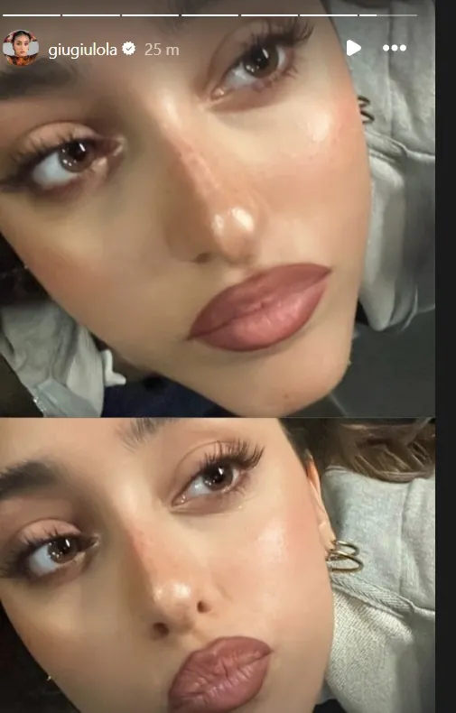 Giulia Stabile Ritocco Labbra